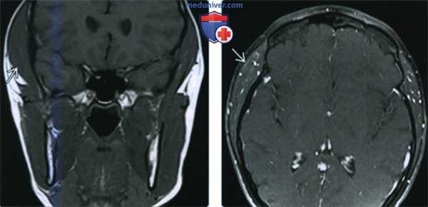 Доброкачественная гипертрофия жевательной мускулатуры - лучевая диагностика