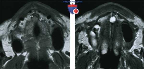 Киста носонебного протока - лучевая диагностика