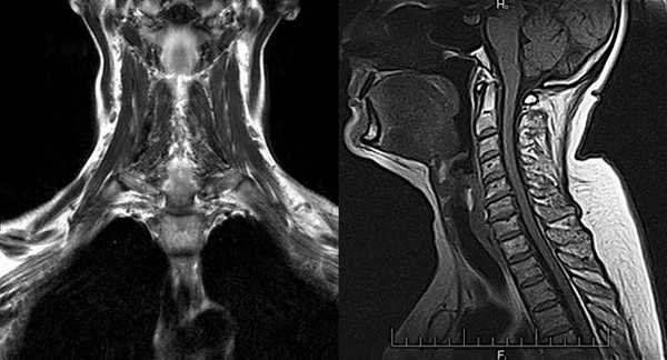 Магнитно-резонансная томография шеи и полости рта 