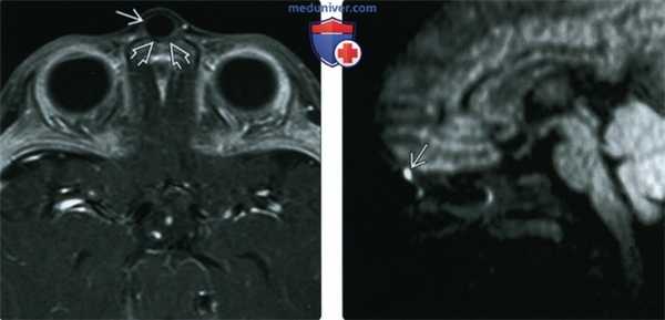КТ, МРТ при дермальном синусе носа