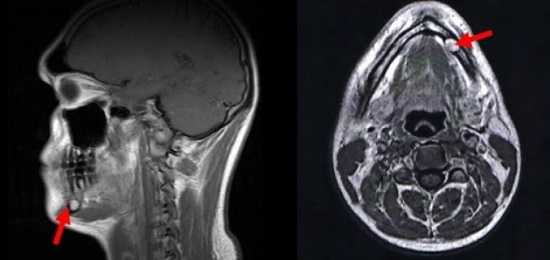 МРТ зубов, что показывает