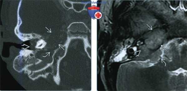 Метастатическое поражение височной кости - лучевая диагностика