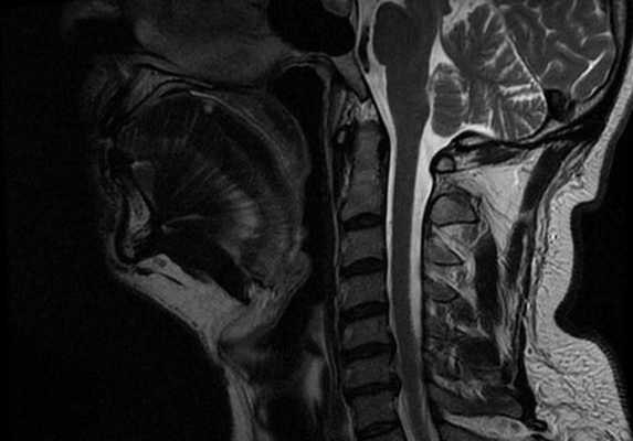 Магнитно-резонансная томография полости рта, снимок сделан в сагиттальной плоскости