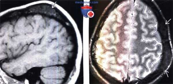 Фиброзная дисплазия на КТ головы