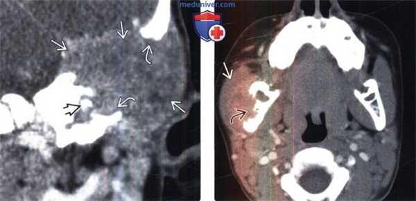 КТ головы при гистиоцитозе из клеток Лангерганса