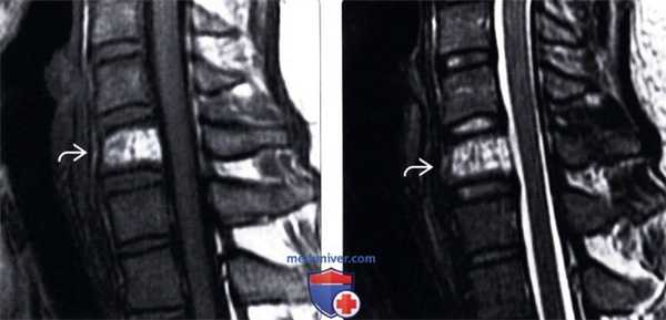 МРТ гемангиомы позвоночника