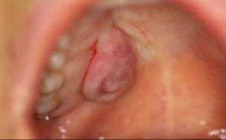 Плеоморфная аденома малых слюнных желез в области неба