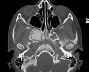 Фиброзная дисплазия ЛОР-органов
