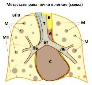 мтс_в_легкие