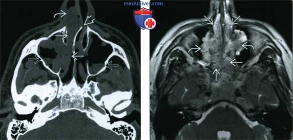 КТ, МРТ при полипозе носа и пазух