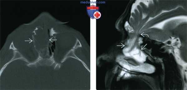 КТ, МРТ при фронтоэтмоидальном цефалоцеле