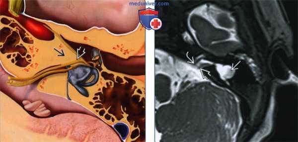 Аплазия лабиринта - лучевая диагностика