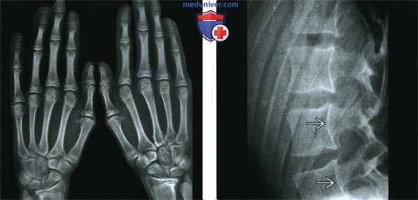 Синдромы Марфана и Элерса-Данлоса - лучевая диагностика