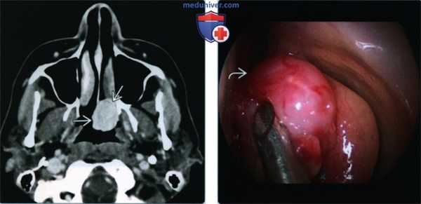 Синоназальная гемангиома - лучевая диагностика