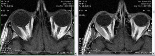  Применение МРТ при заболеваниях глаз