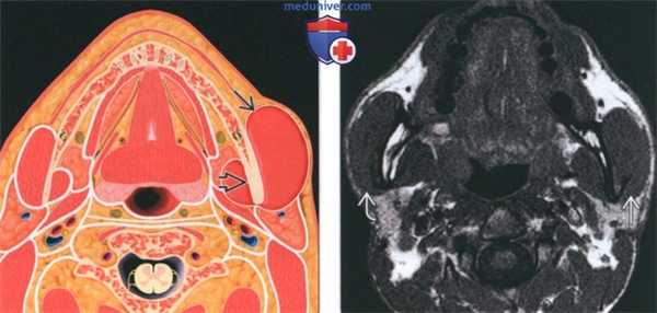 УЗ-признаки доброкачественной гипертрофии жевательной мышцы