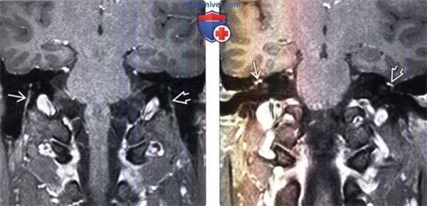 МРТ признаки паралича Белла