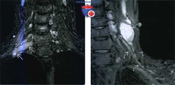 Шваннома плечевого сплетения - лучевая диагностика