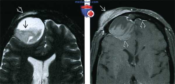 КТ, МРТ при мукоцеле пазух носа