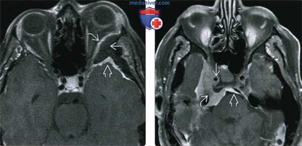 КТ, МРТ при менингиоме основания черепа