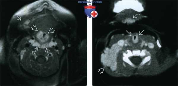 Младенческая гемангиома верхних дыхательных путей - лучевая диагностика