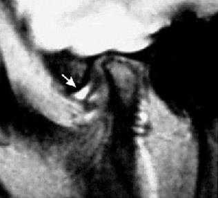 МРТ височно-нижнечелюстных суставов в диагностике заболеваний ВНЧС