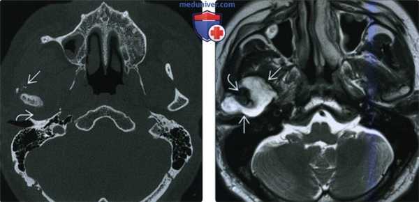 КТ, МРТ при хондросаркоме жевательного пространства