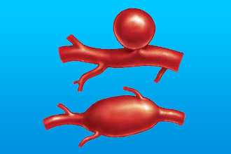 Как выглядит аневризма