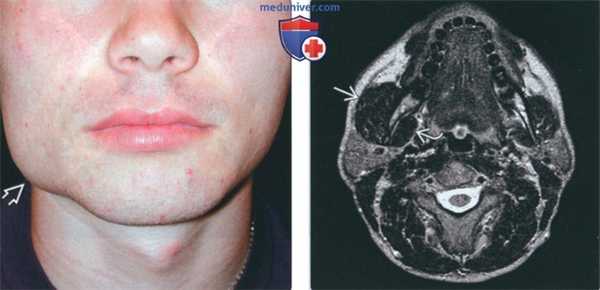 Лучевая диагностика доброкачественной гипертрофии жевательных мышц