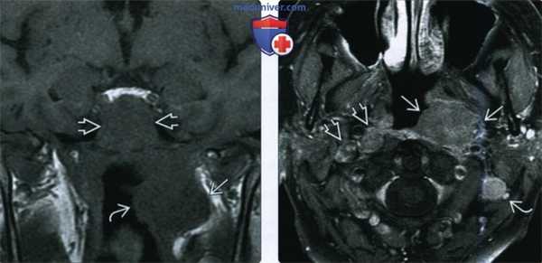 КТ, МРТ при раке носоглотки