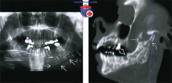 КТ, МРТ при остеорадионекрозе головы и шеи