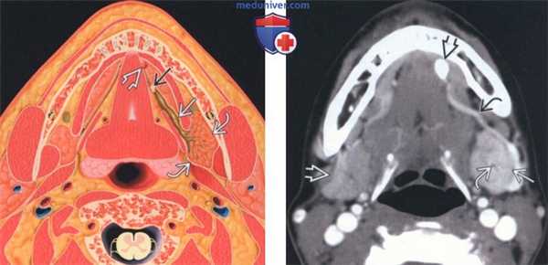 Лучевая диагностика поднижнечелюстного сиаладенита