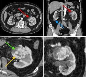 РАК_ПОЧКИ_КОНТРАСТ