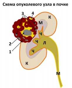 СХЕМА ОПУХОЛЕВОГО УЗЛА