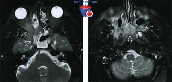 КТ, МРТ при внутричерепном идиопатическом воспалительном псевдотуморе