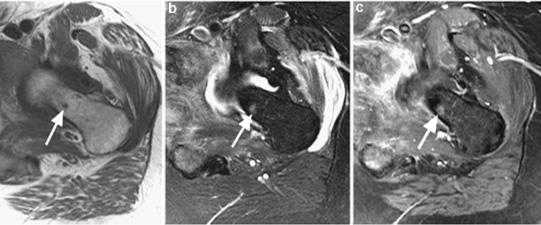МРТ малого таза в диагностике заболеваний мочевого пузыря
