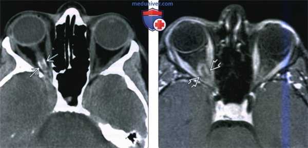 КТ, МРТ при менингиоме оболочек зрительного нерва