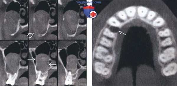Лучевая диагностика синдрома базальноклеточного невуса челюсти