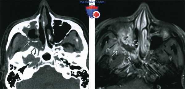 КТ, МРТ при инвазивном грибковом синусите