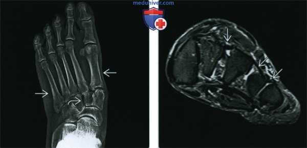 Синдромы Марфана и Элерса-Данлоса - лучевая диагностика