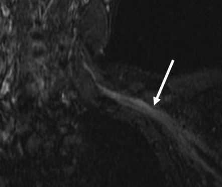 повреждение плечевого сплетения