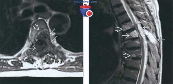 КТ, МРТ при гемангиоме шейных позвонков