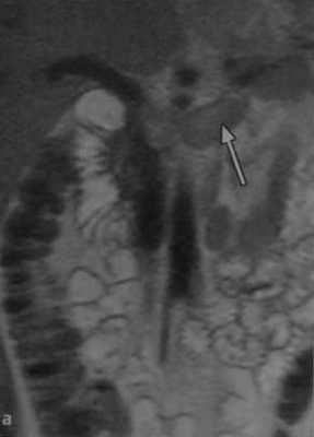 Снимки МРТ и КТ. Тромбоз почечной вены