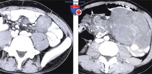 Рентген, КТ, МРТ, УЗИ при десмоидной опухоли (десмоиде)