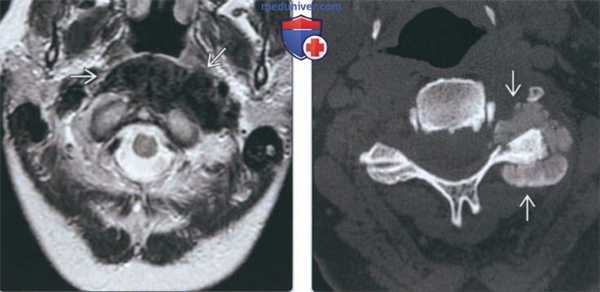 Лучевая диагностика туморального кальциноза
