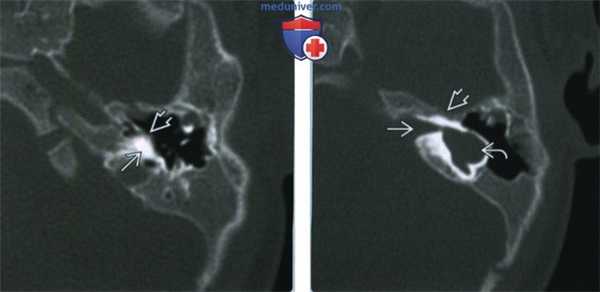 Аплазия лабиринта - лучевая диагностика