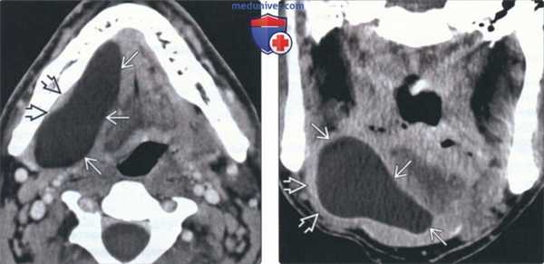 КТ, МРТ при рануле