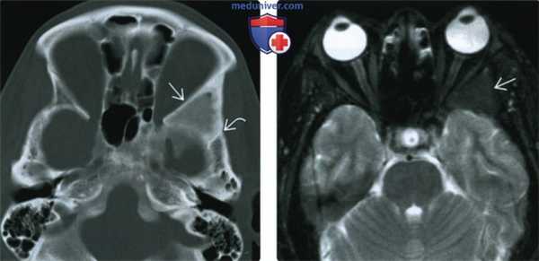 КТ, МРТ при фиброзной дисплазии основания черепа