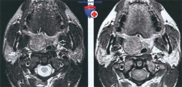 КТ, МРТ при неходжкинской лимфоме слизистой оболочки глотки