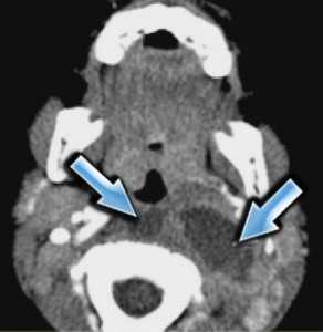ретрофарингеальный абсцесс-обр